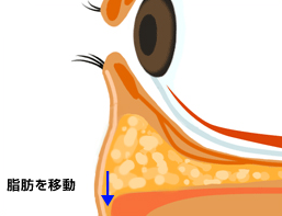 ハムラ法の流れ3