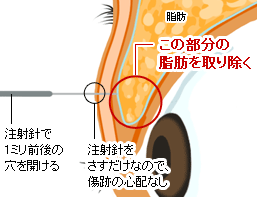 脂肪を除去の流れ4